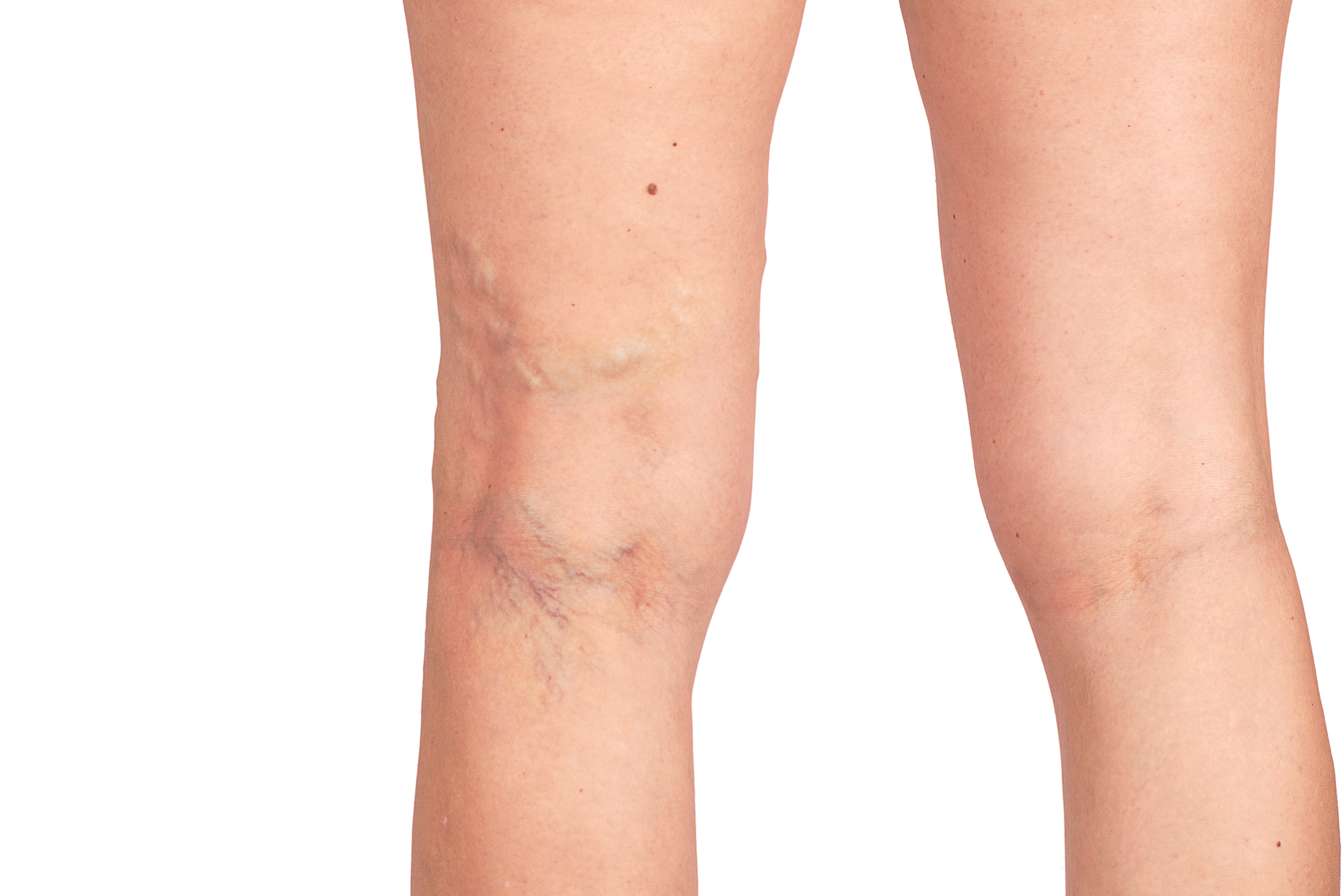 varicose veins